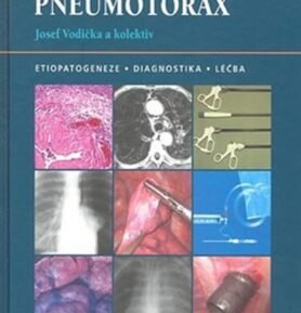 Spontánní pneumotorax - Josef Vodička