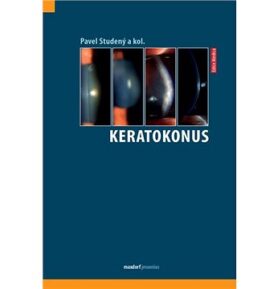 Keratokonus